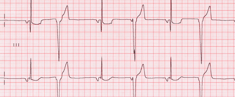 Resultado de imagen para Ondas no periodicas electrocardiogramas