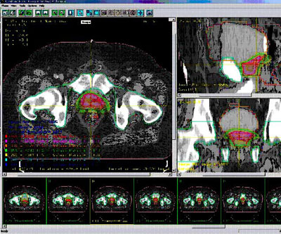 Split Field Radiotherapy RADIOTHERAPY at emaze Presentation