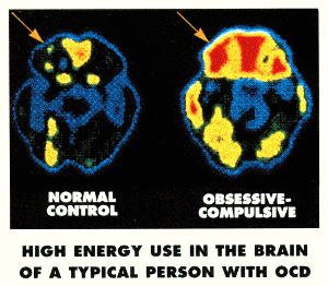 A case study of obsessive-compulsive disorder some diagnostic considerations