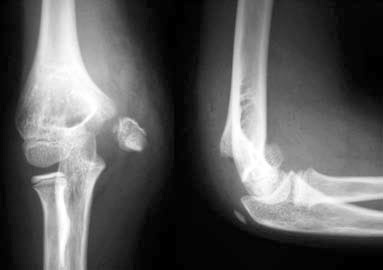 Fractura de humero on emaze