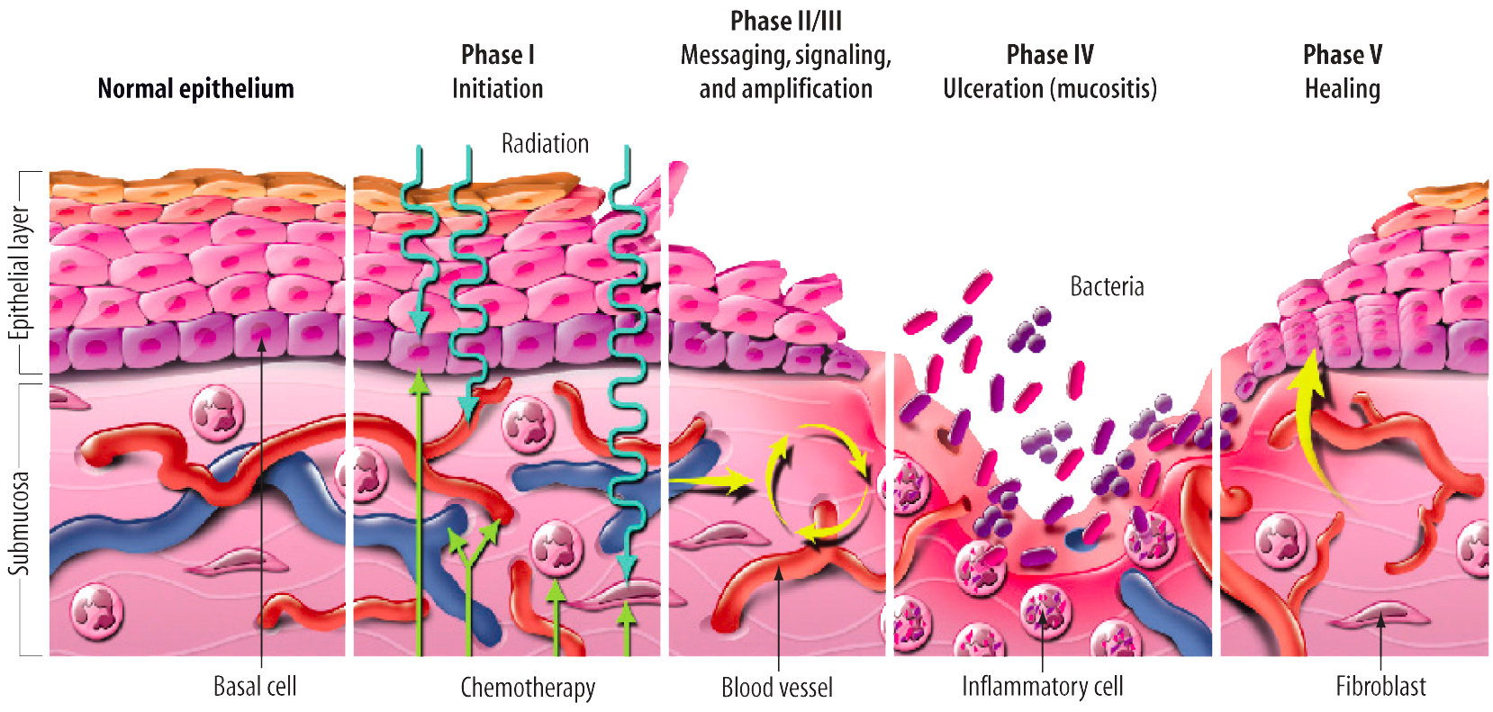 Oral Mucositis on emaze