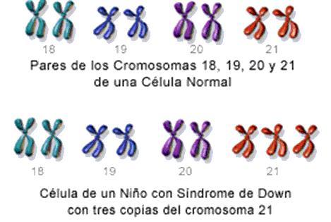 Resultado de imagen para sindrome de down genetica