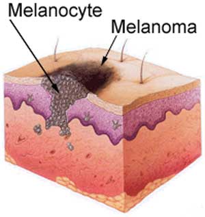 Melanoma on emaze