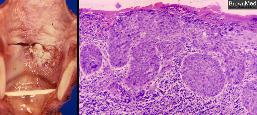 ass-undifferential-carcinoma-in-young-girl