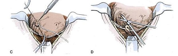 Urologia- reimplante on emaze
