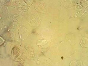 Filamentos De Mucina En Orina Moderada A Partir De Qual Temperatura E Considerado Febre Em Bebe