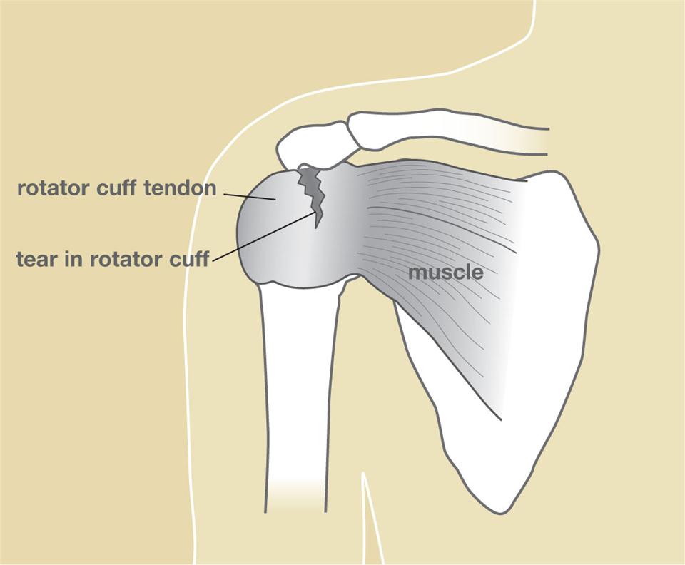 Разрыв ротаторной. Ротаторная манжета плечевого сустава. Ротаторная манжета плечевого сустава анатомия. Повреждение ротаторная манжета. Ротаторная манжета плечевого сустава надрыв.