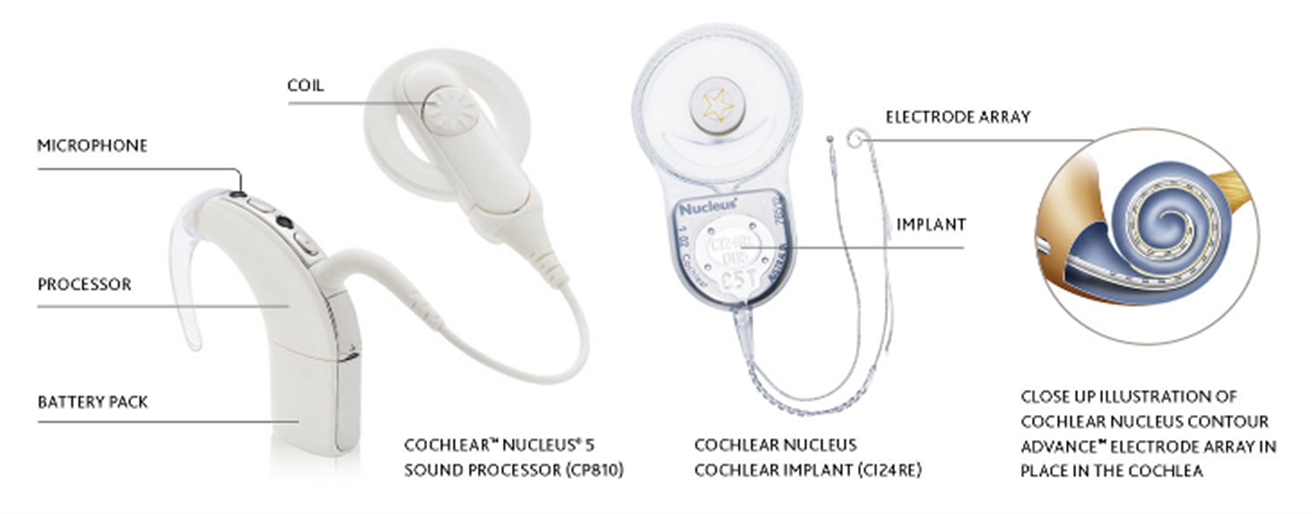 Евромакс кохлеарные импланты интернет магазин. Кохлеарная имплантация Cochlear 7. Кохлеар нуклеус кохлеарный имплант.