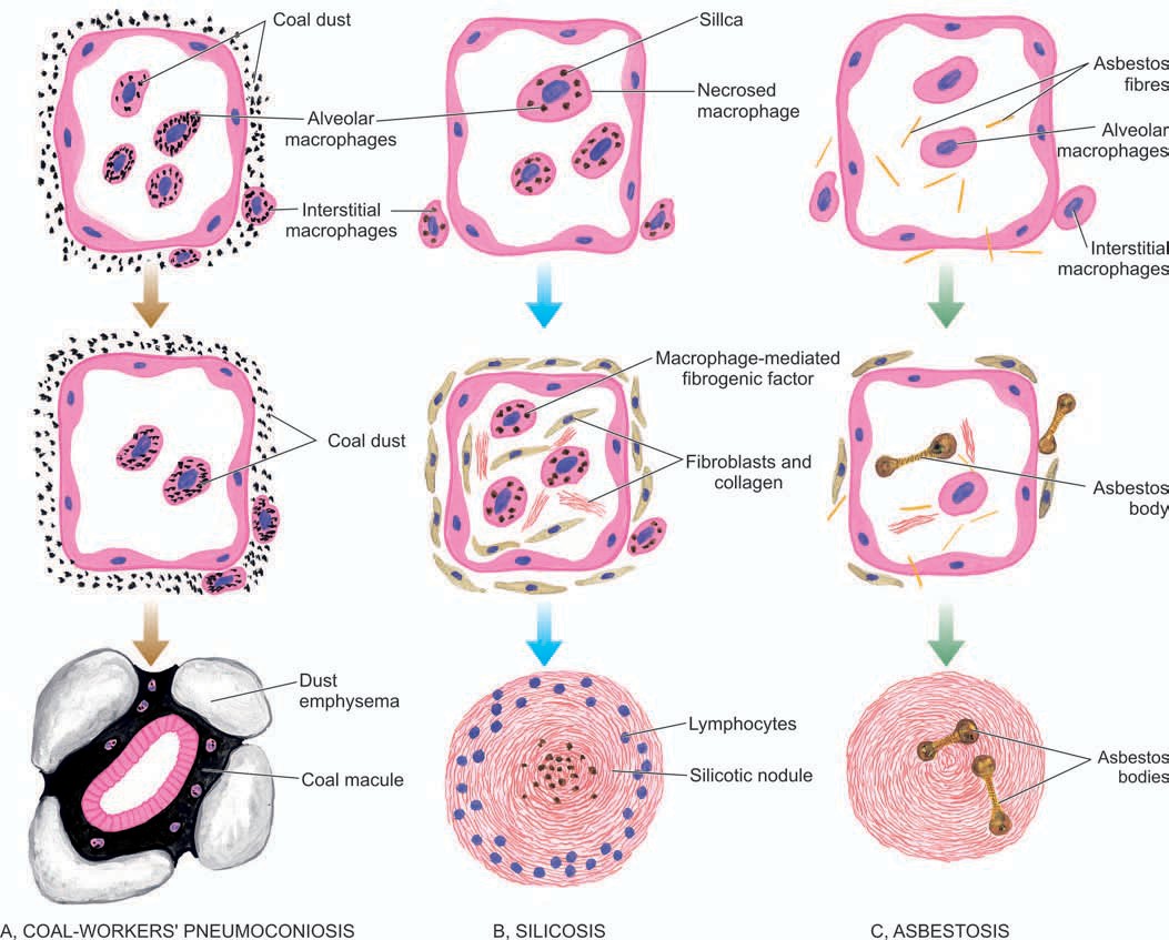 PAL 3 Occupational Lung diseaes & Pulmonary hypertension.pptx on emaze