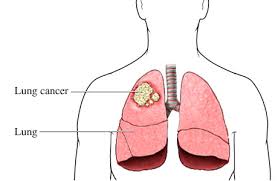 Lung Cancer on emaze