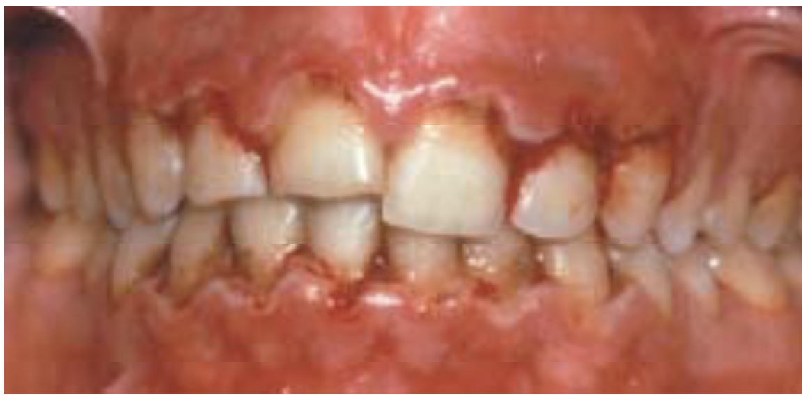 Gingivitis Ulcerativa Necrotizante