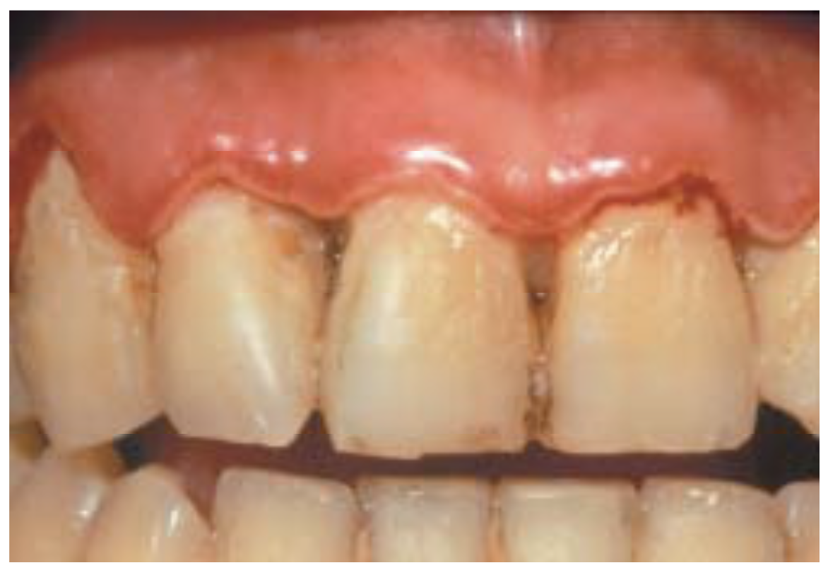 Gingivitis Ulcerativa Necrotizante