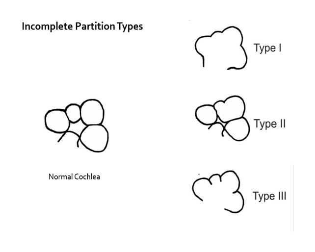 inner ear malformations at emaze Presentation