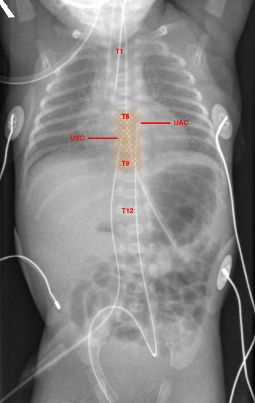 NICU CASE STUDY on emaze