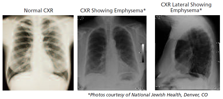 Copd On Chest X Ray