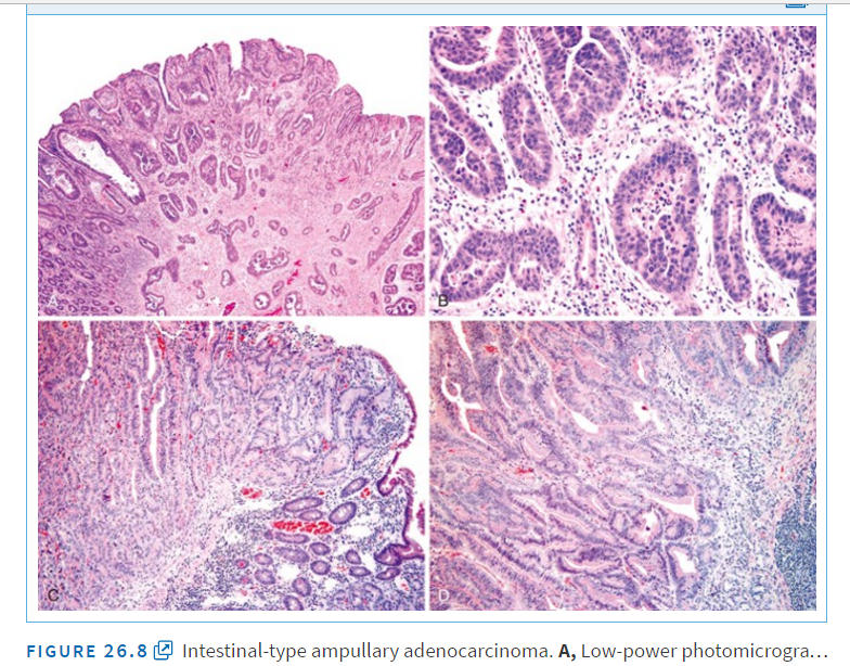 Аденокарцинома low grade. Аденома бдс гистология. Фатеров сосочек гистология. Аденокарцинома кишечника микропрепарат. Протоковая аденокарцинома бдс гистология.