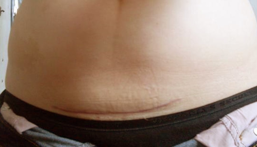 C Section Procedure