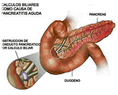 Calculos biliares dieta