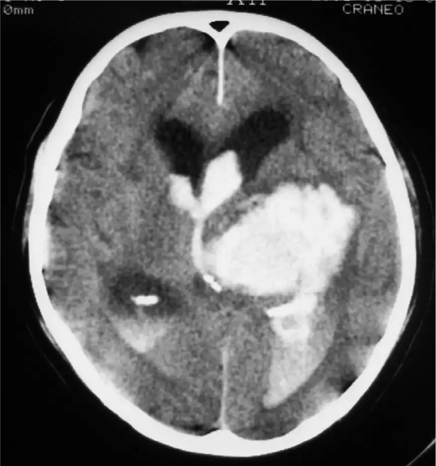 Hominick Hematoma