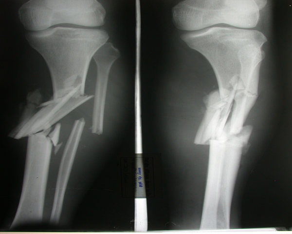 Types of Bone Fractures at emaze Presentation