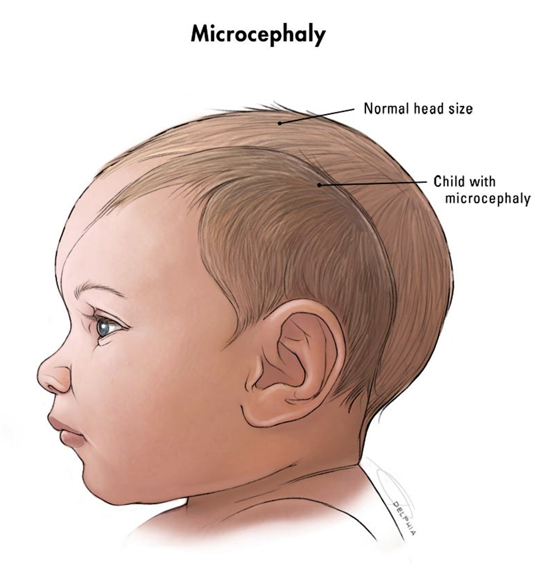 Маленькая окружность головы. Микроцефалия врожденная. Форма головы новорожденного. Нормальная форма головы у ребенка. Форма головы у новорожденного ребенка.