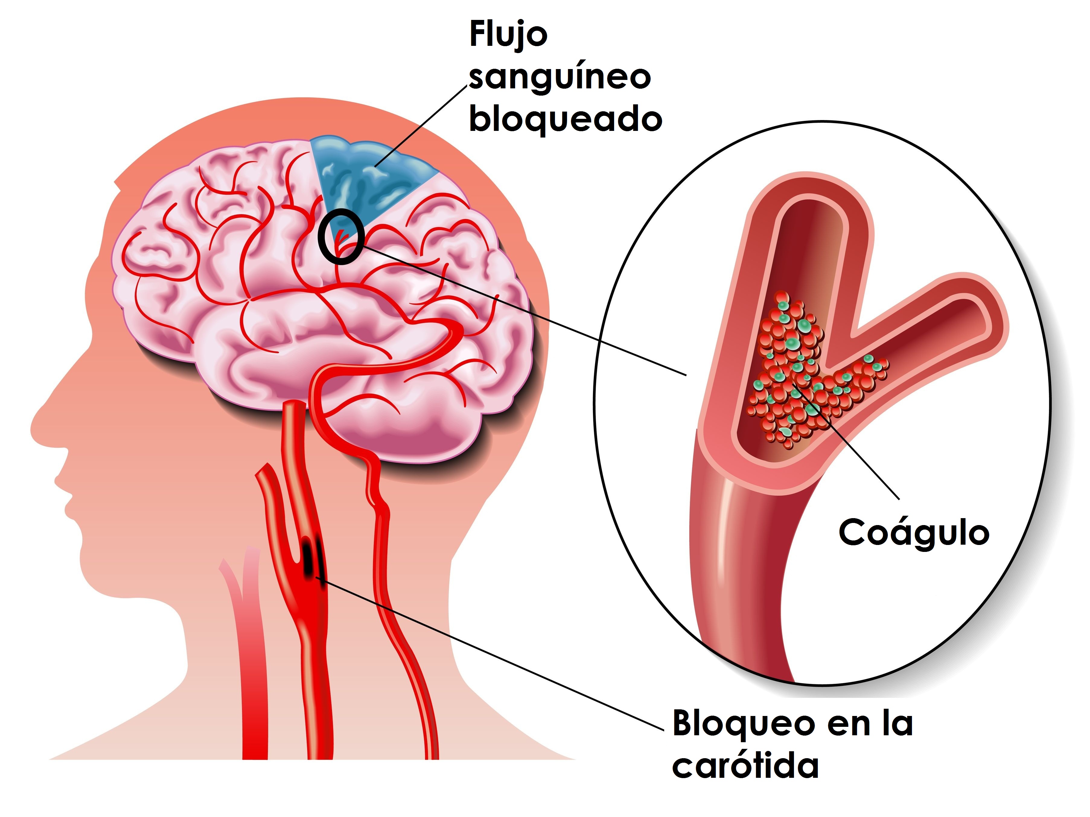 DERRAME CEREBRAL at emaze Presentation