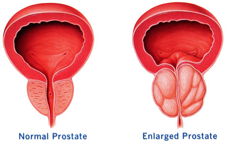 una prostata grande