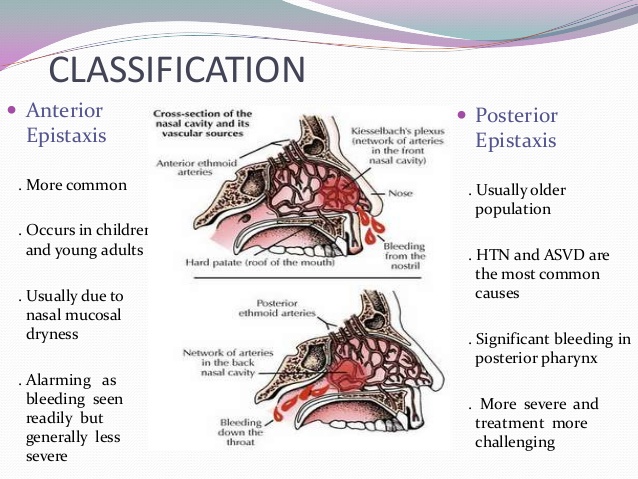 EPISTAXIS on emaze