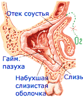 Соустье. Соустье гайморовой пазухи. Соустье верхнечелюстной пазухи. Соустье верхнечелюстной пазухи в полости носа.