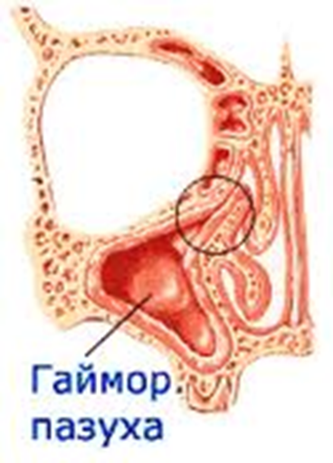 Воздух в пазухах. Н гаймор. В пазухе только воздух.