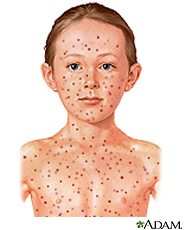 Chicken Pox vs. Shingles at emaze Presentation