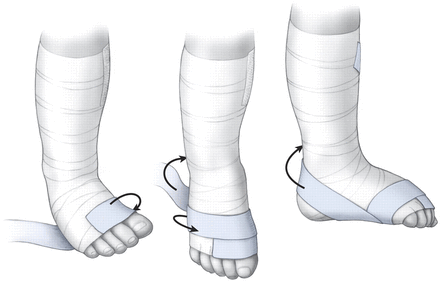 Clubfoot Splint Pattern Clubfoot talk at emaze Presentation