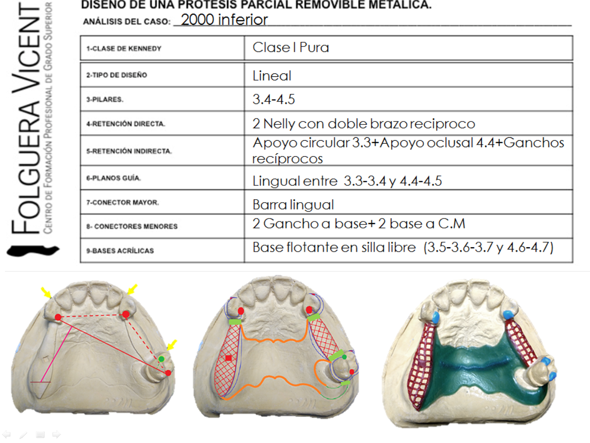 Diseño De Protesis Parcial Removible Clase 3 - Variaciones Clase