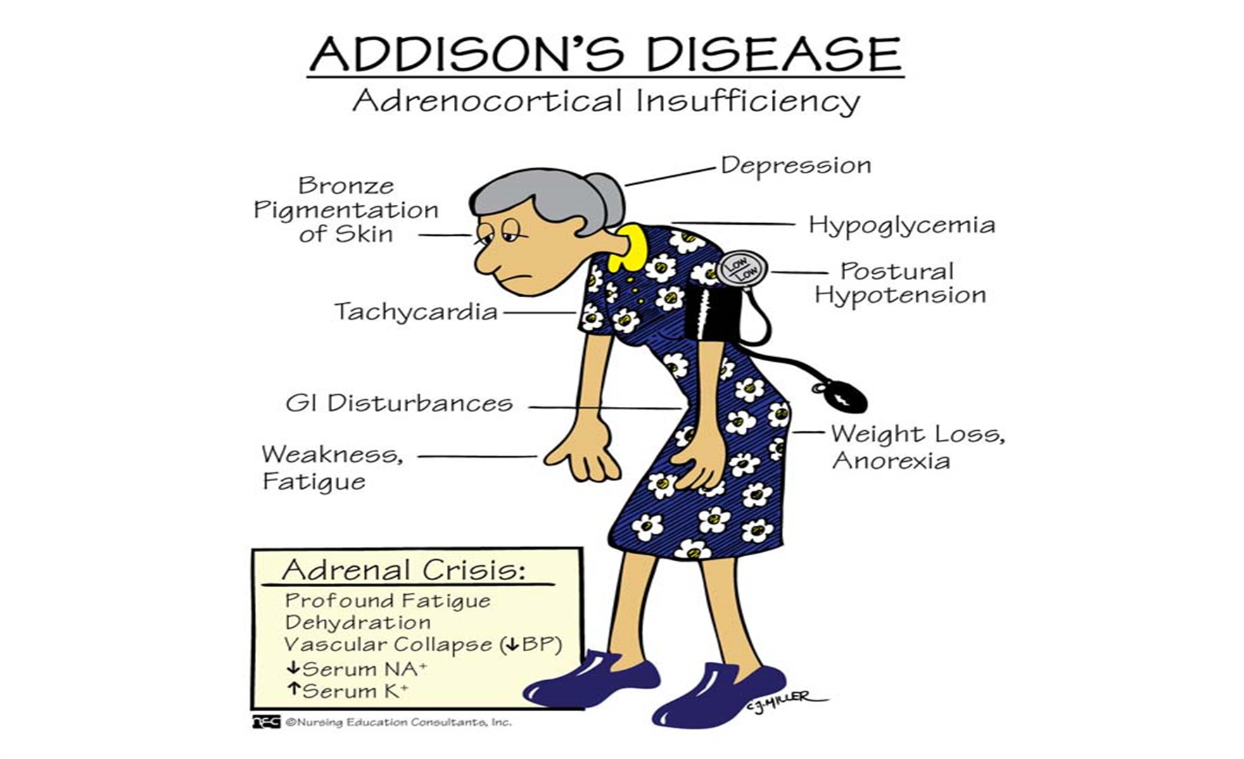 Клинические проявления болезни Аддисона. Болезнь Аддисона патогенез. Болезнь Аддисона бронзовая болезнь. Болезнь Аддисона патогенез основных проявлений.