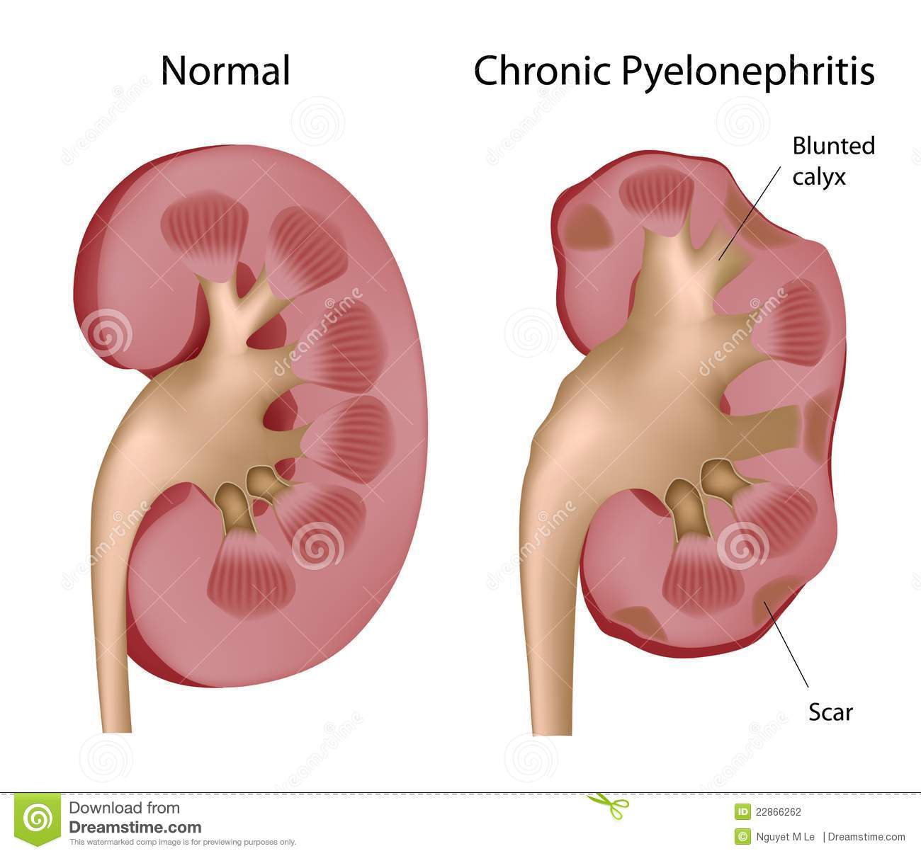 Pyelonephritis on emaze