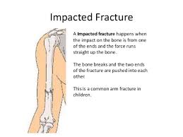 comminuted fracture common location