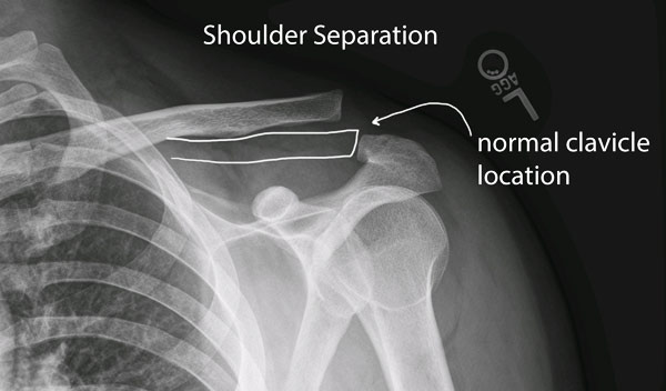 Shoulder Separation on emaze