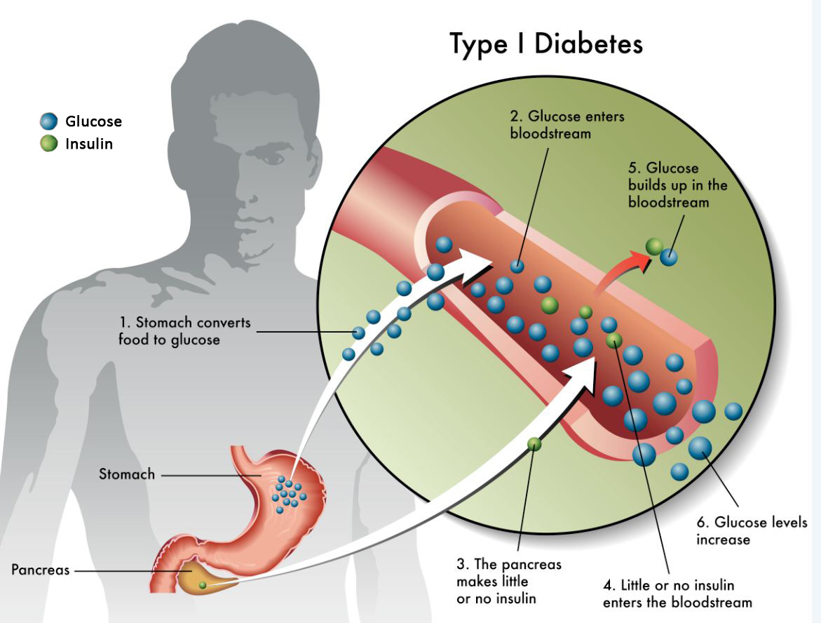 DIABETES MELLITUS Mind Map