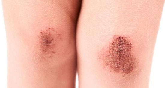 Necrotizing Fasciitis on emaze