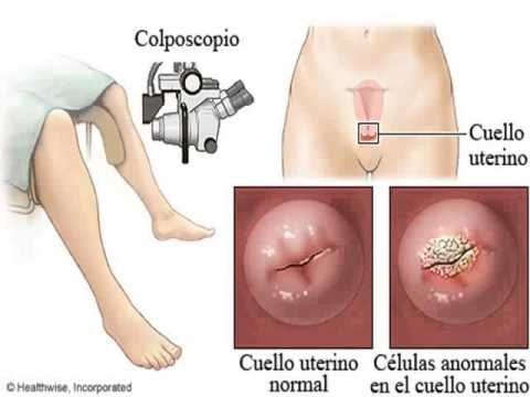 Cancer que del cuello uterino el sintomas da