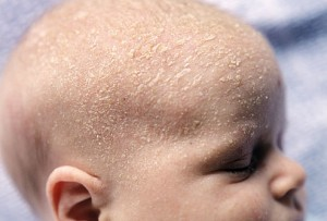 Resultado de imagen de dermatitis seborreica en bebes