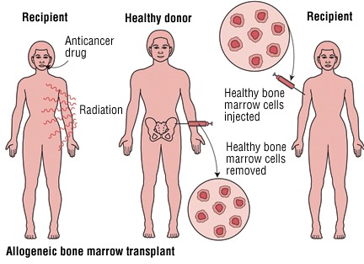 Трансплантация костного мозга. BMT Bone marrow трансплантация костного мозга. Аллогенная трансплантация.