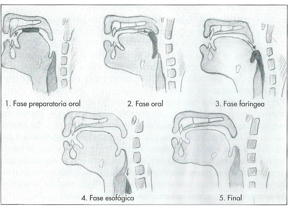 Disfagia como consecuencia a EM on