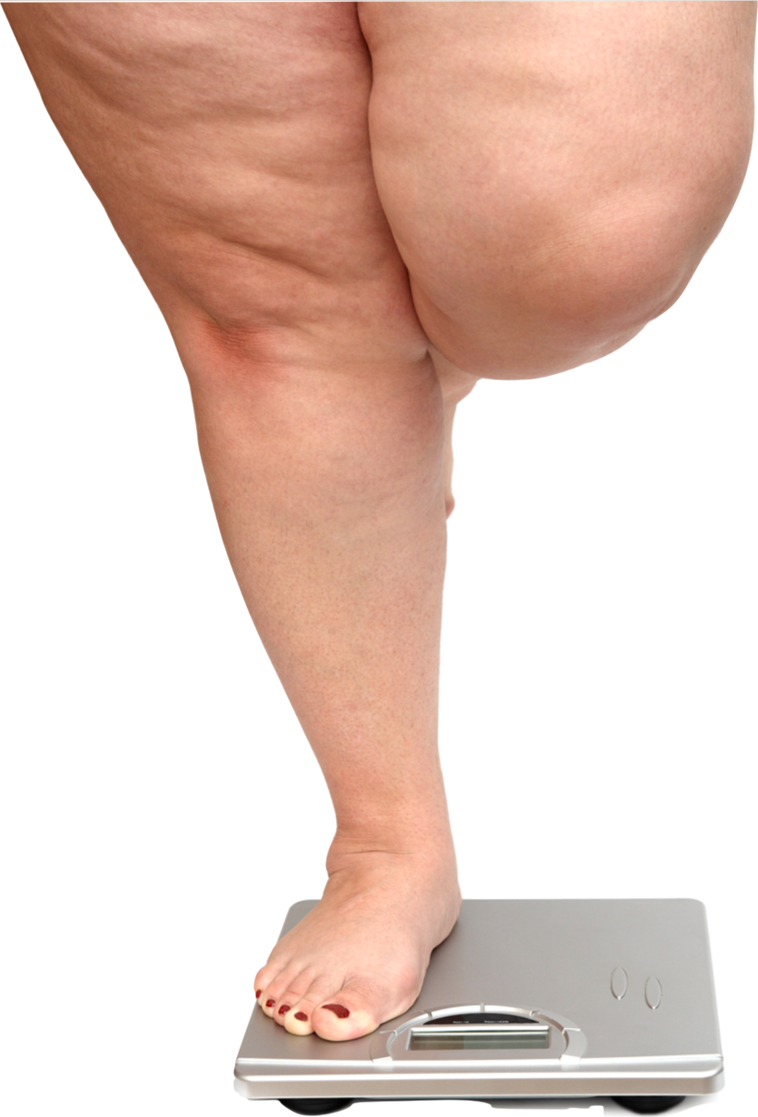 Ноги у толстых людей