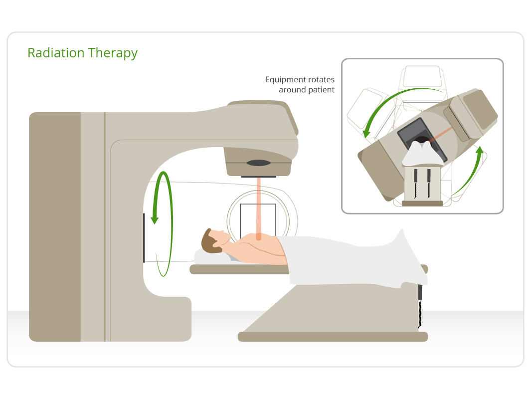 Лучевая радиотерапия. Трехмерная конформная лучевая терапия. Трехмерная конформная лучевая терапия (3d-CRT). Гамма излучение лучевая терапия. Лучевая терапия схема.