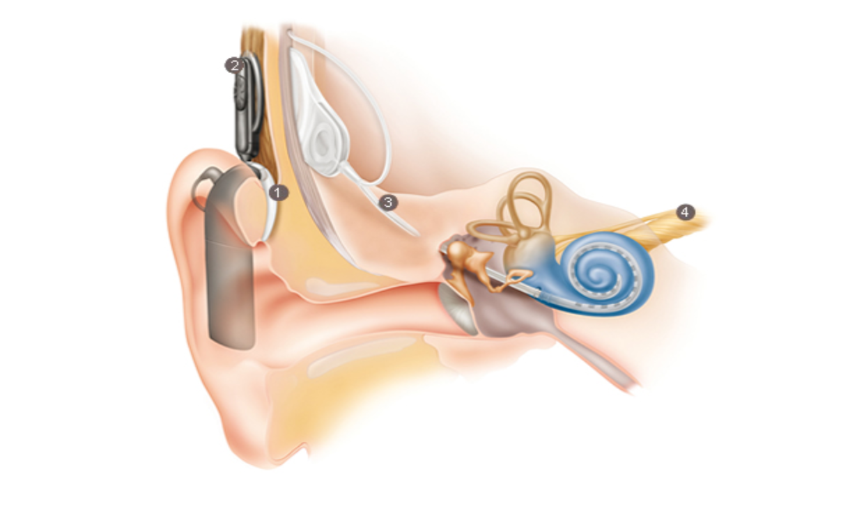 Кохлеарный имплант аппараты