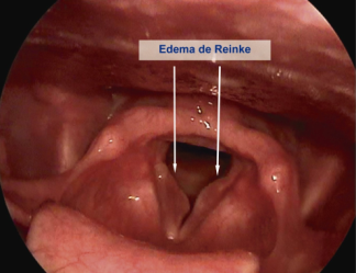 Resultado de imagen para edema de reinke