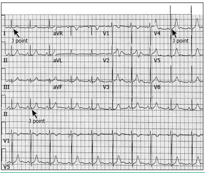 ECG on emaze