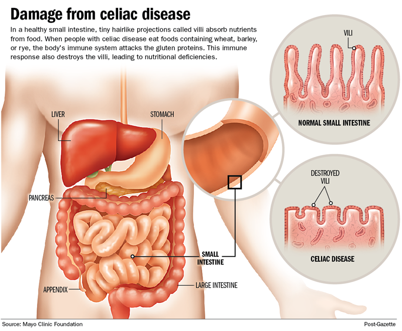 dating someone with celiac disease Celiac disease what is celiac disease people with celiac disease cannot eat gluten gluten is a protein found mainly in wheat created date. dating someone with celiac disease Celiac disease what is celiac disease people with celiac disease cannot eat gluten gluten is a protein found mainly in wheat created date.