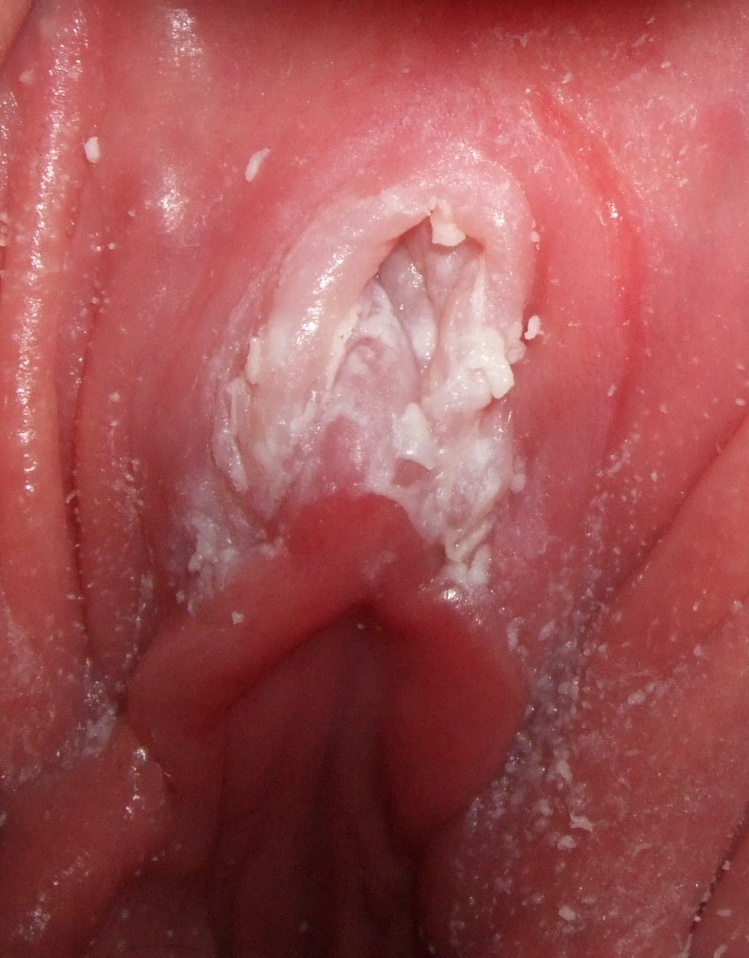 Vaginal Rash